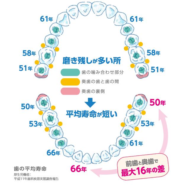 インプラント